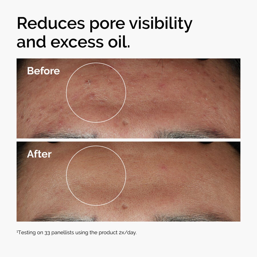 niacinamide-10-zinc-1-f7 ord-niacinamide-zinc-blemish-serum-before-after-pores.jpg