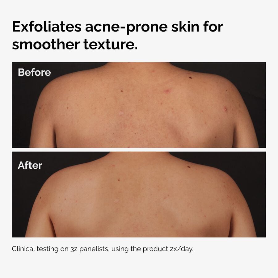 salicylic-acid-0-5-body-serum-z3 ord-salicylic-acid-body-serum-before-after-graphic-NA.jpg